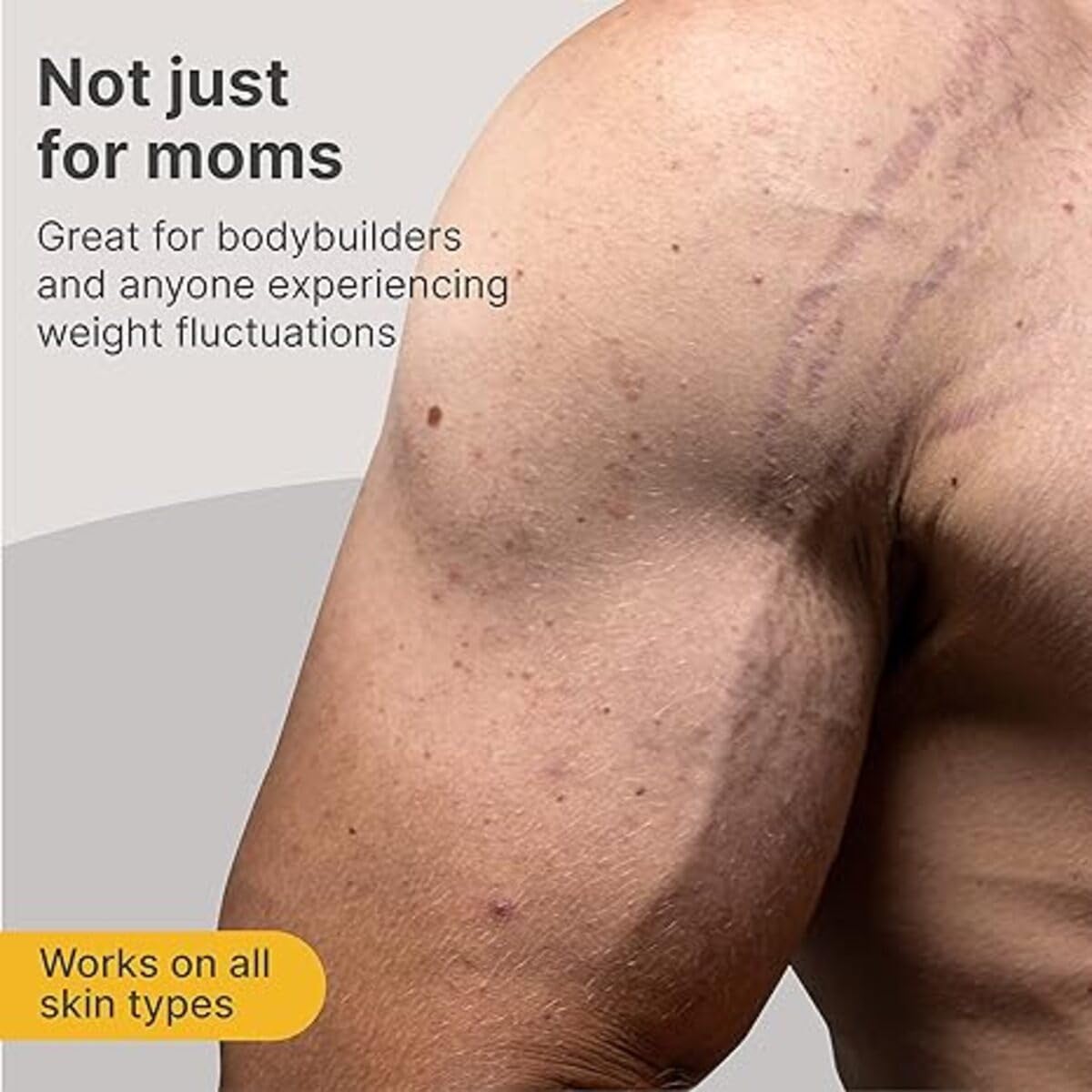Stretch Marks Removal and Reduce Cream,Stretch Marks & Scars,All SkinTypes,Safe for Pregnancy Maternity Skin Care|Dermatologically Tested | Even Toned Skin with Goodness| 100g