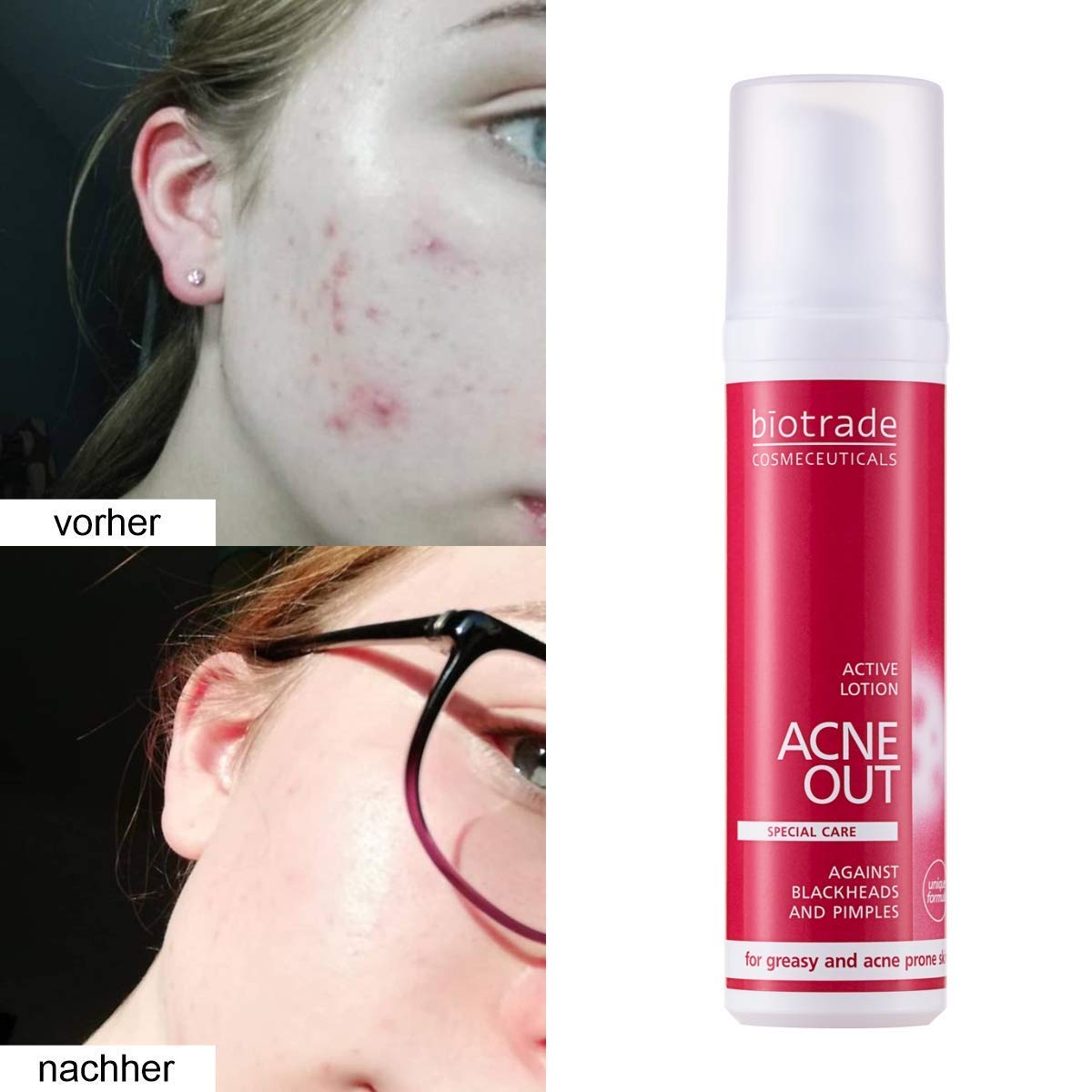 biotrade acne out active cream