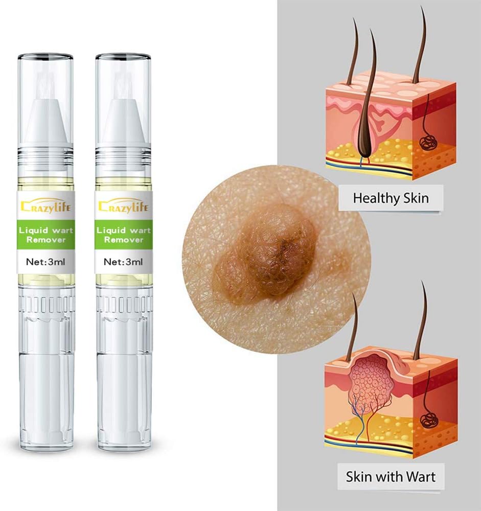 Skin Tag Remover Wart Remover for Neck Quickly Tag Mole Remover for Common and Plantar Warts,2pcs: Health & Personal Care