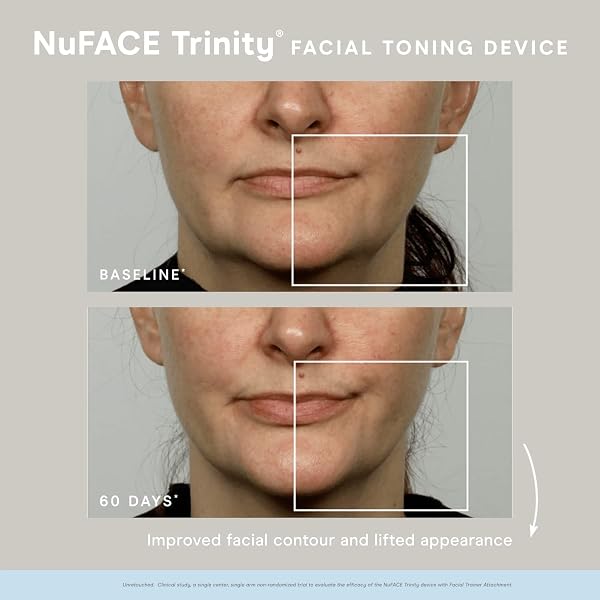 NUFACE TRINITY COMPLETE – FACIAL TONING KIT