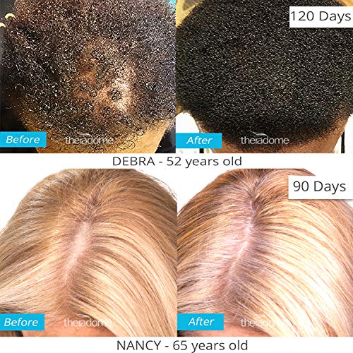 Theradome PRO LH80 Hair Growth Helmet - Image 7