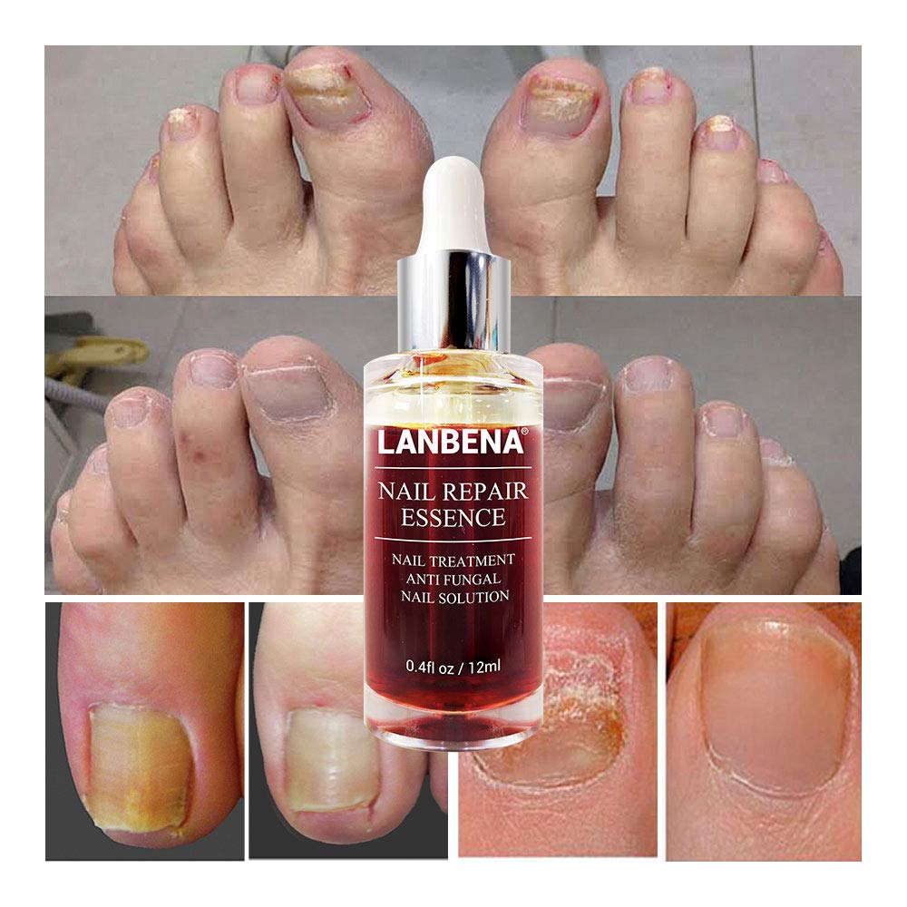 Nails Repair, LANBENA Nail Treatment Nail Care Serum Protect Nail from Damage Fingernail and Toenail Repair for Curing Athlete's Foot and Prevent Nail from Infection Discolored & Damaged Nails(12ml) : Beauty