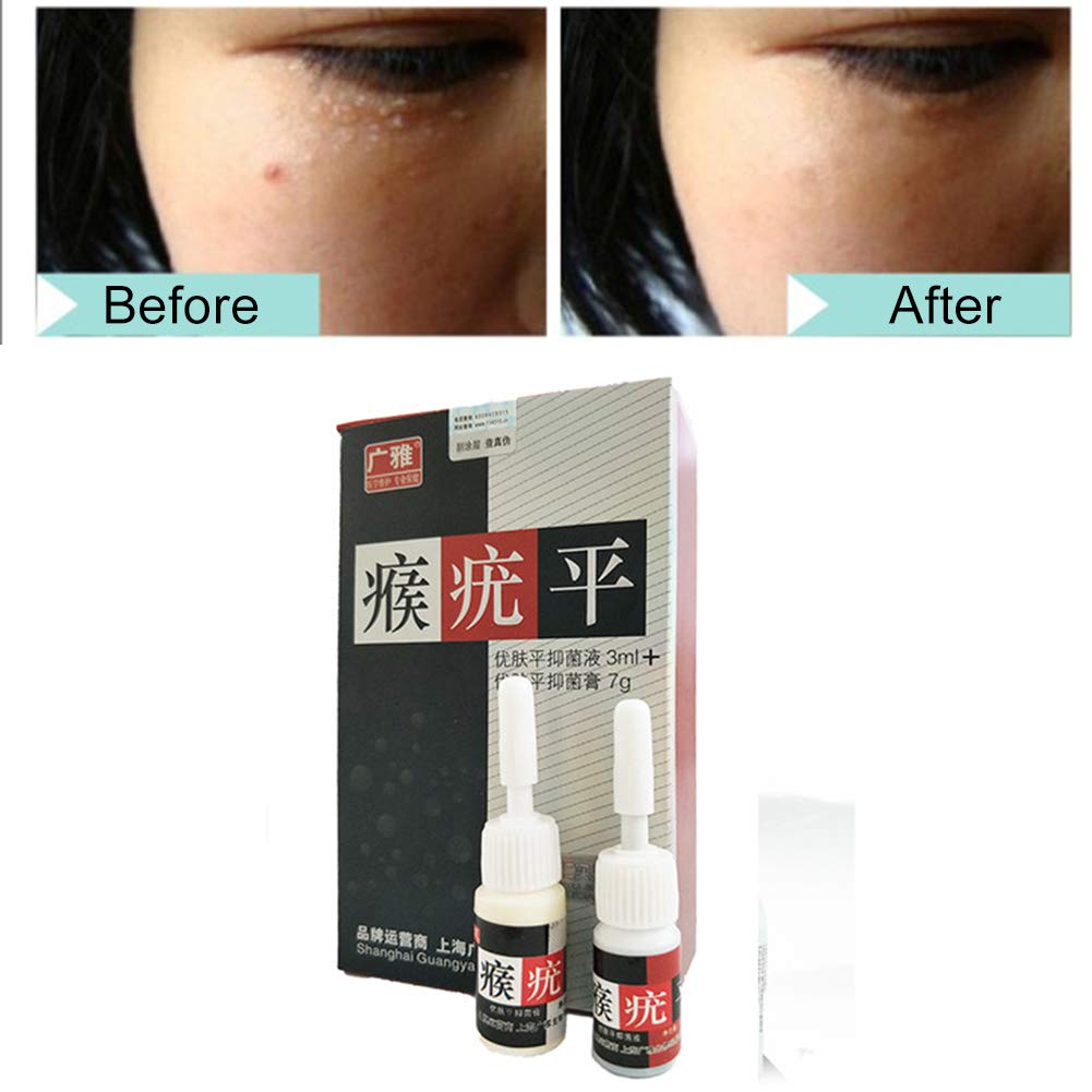 skin mole removal cream
