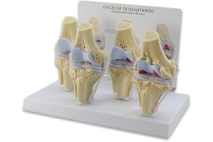 GPI ANATOMICALS Knee Set 3/4 size Osteoarthritis Set of 4 Anatomical Model w Educational Key Card