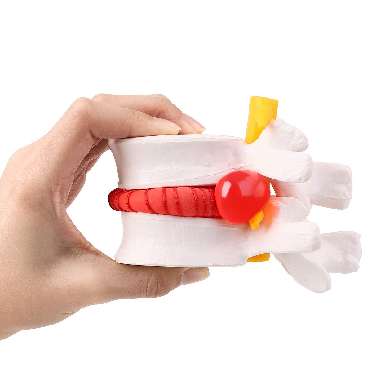 Human Anatomical Lumbar Disc Herniation Model Lumbar Spine Model for