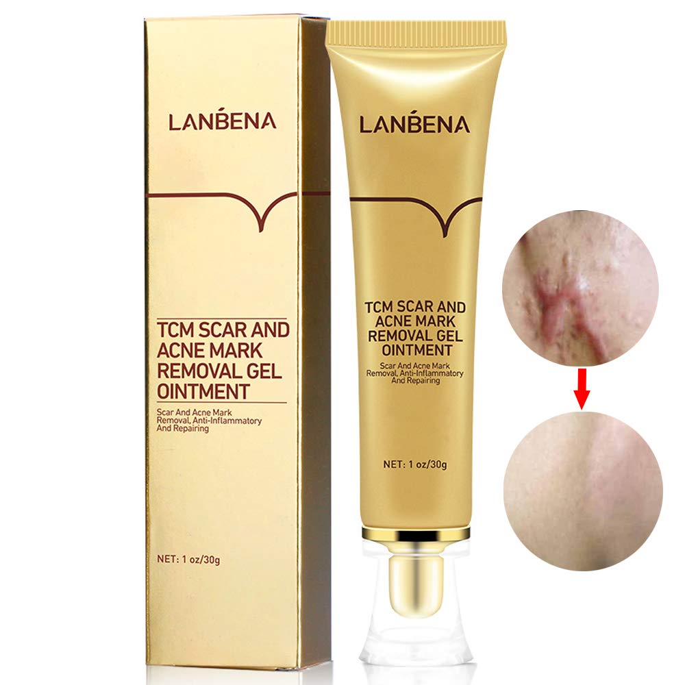 acne star removal cream