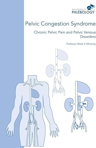 Download Pelvic Congestion Syndrome - Chronic Pelvic Pain and Pelvic Venous Disorders PDF