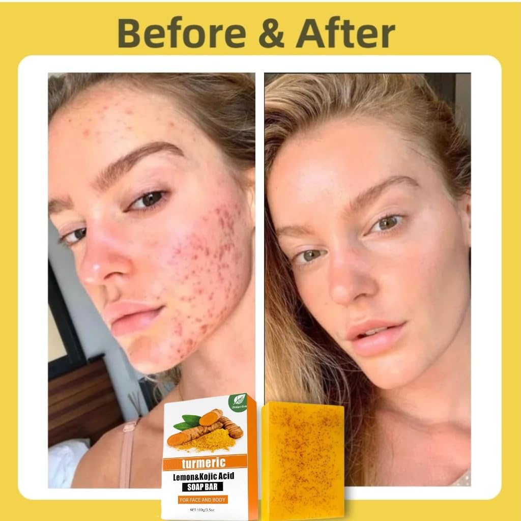 Kojic Acid & Turmeric Soap Bar for Dark Spot removal - Skin Lightening Soap with Vitamin C, Retinol, Shea Butter & Lemon Oil - for Face, Body, Underarms - SLS Free, for Oily & Dry Skin