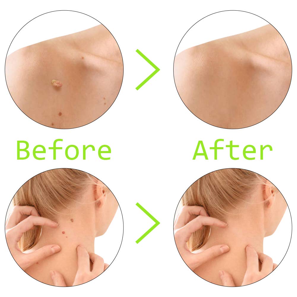 Micro Skin Tag Remover Device for Small to Medium Skin Tags : Beauty
