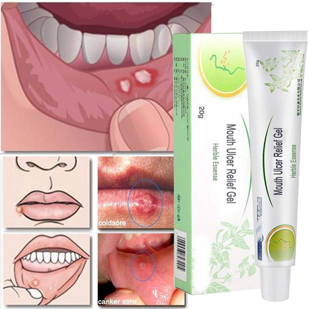 Mouth Ulcer Relief Gel Natural Herbal Ingredients Oral Antibacterial Cream Fast Relief From Severe Pain - 
