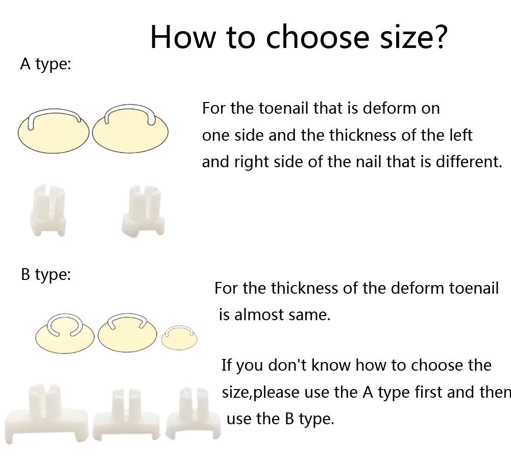 Ingrown Pincer Paronychia Toe Nail Straightening Correction Treatment