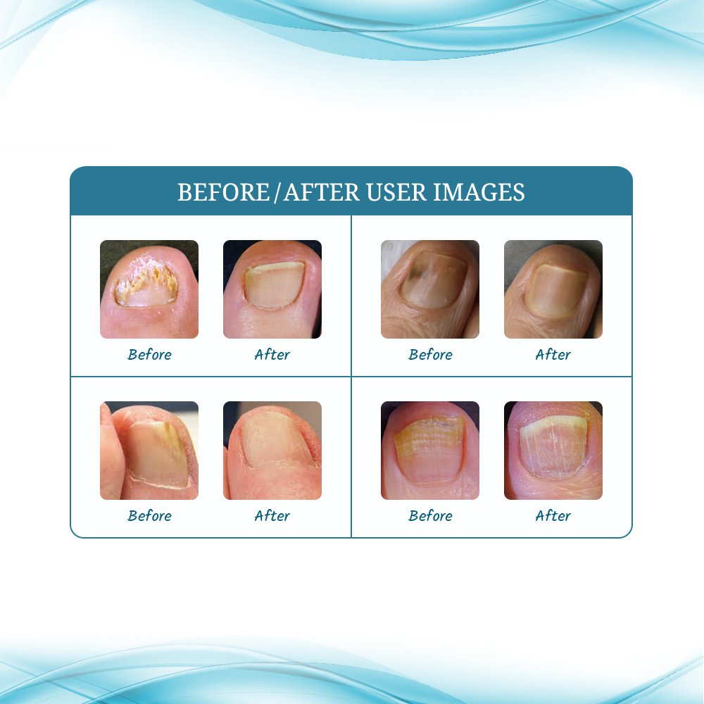 Funginix Nail Fungus Treatment and Funginix AF Athlete's Foot Treatment