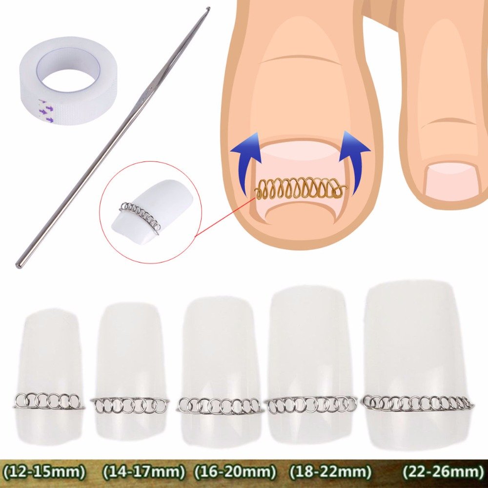 Ingrown Pincer Paronychia Toe Nail Straightening Correction Treatment