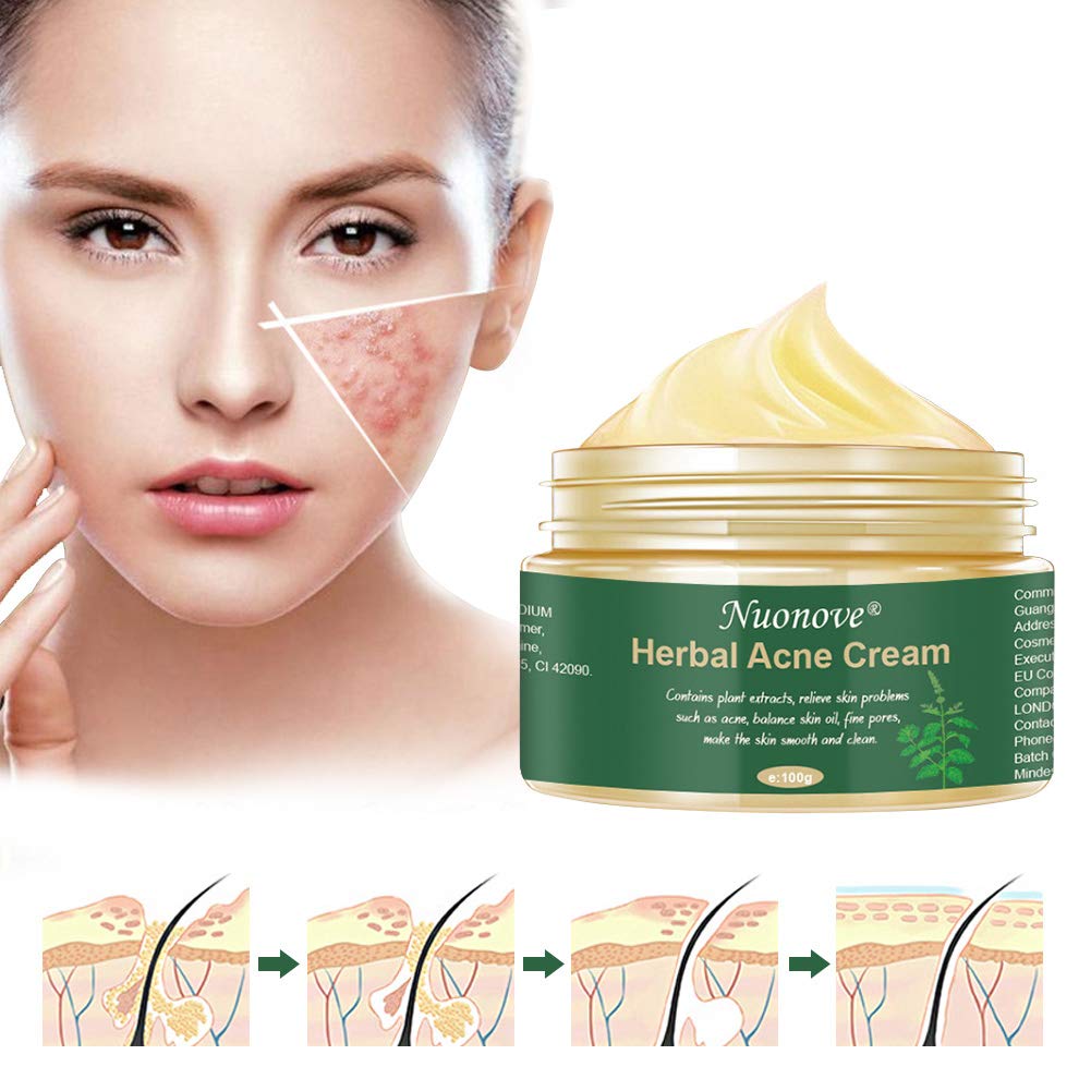 herbal acne cream price