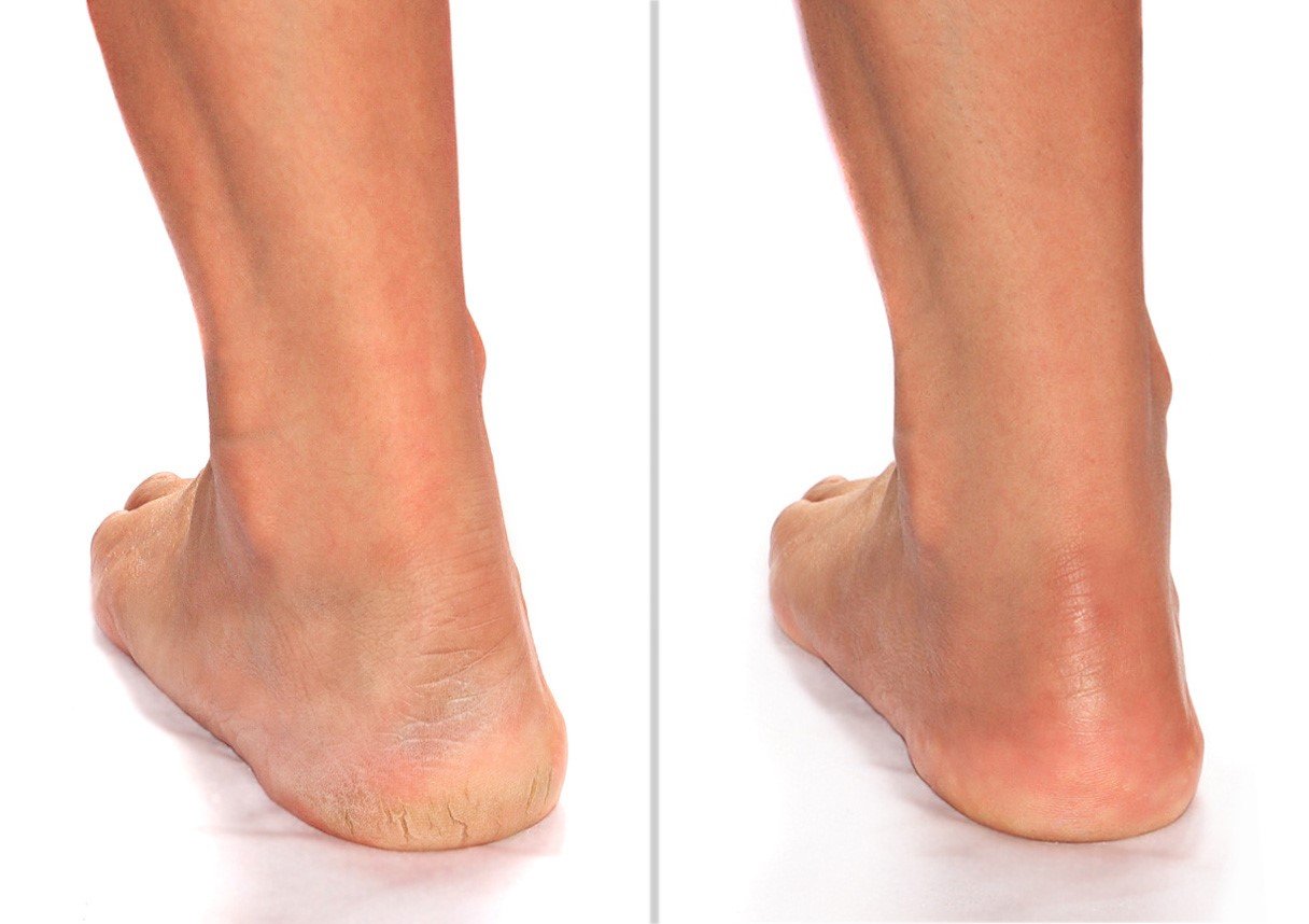Advanced Clinicals Callus Cream. Best Foot Cream for callus and rough spots. For Rough Dry Skin on Feet, Hands, Elbows. (8oz): Health & Personal Care