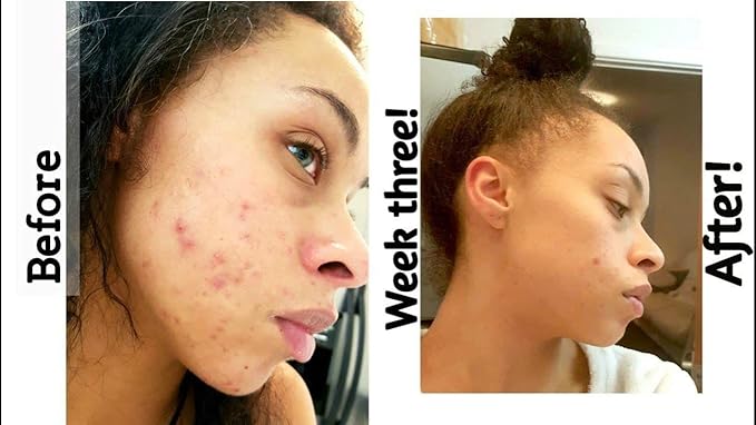 the ordinary retinol 0.2 in squalane for acne scars