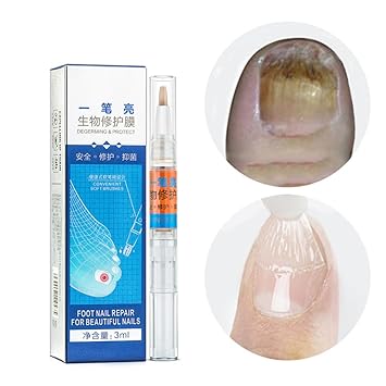 Thumbnail Infection Treatment amazon com 1pc fungal nail treatment pen onychomycosis paronychia anti fungal nail infection chinese herbal nail fungus treatment beauty