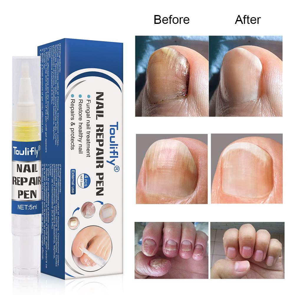 Nail Repair, Nail Repair Pen, Nail Solution, Natural Nail Treatment, Effective Against Nail Infection Restores Discolored & Damaged Nails 4pc : Beauty