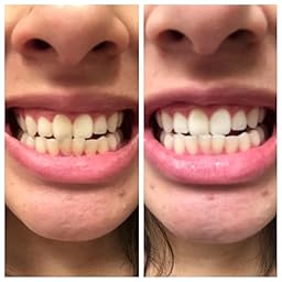 Amazon teeth whitening dr
