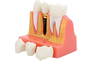 Annhua 4 Times Dental Implant Teeth Model Analysis Crown Bridge Demonstration Model, Dental Teeth Crown Roots Removable for Education, Patients Communication, Learning and Lab