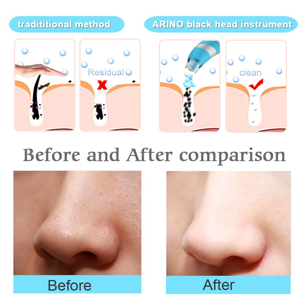 Blackhead Remover, Electric Facial Pore Cleanser Blackhead Removal Tool Pore Vacuum Extraction Tool Facial Pore Cleaner