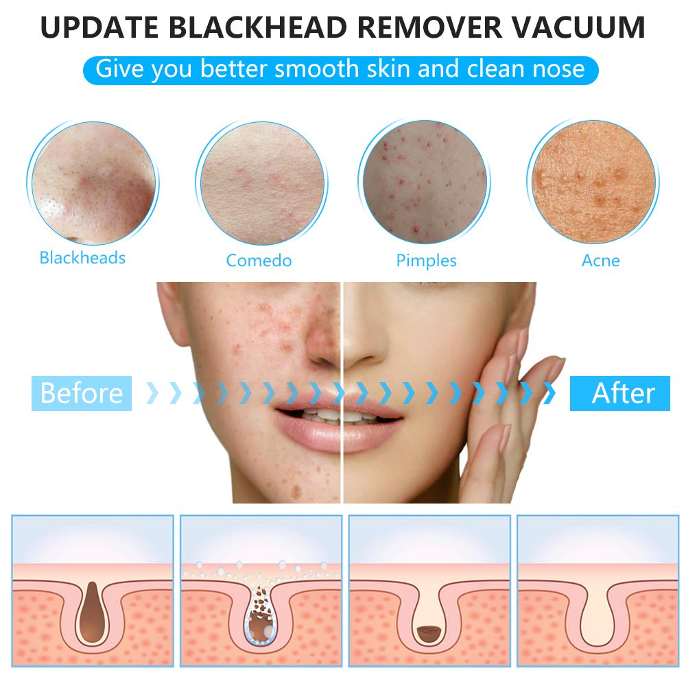 Blackhead Remover Pore Vacuum, Enarit Electric Blackhead Remover Vacuum with Base, Facial Blackhead Extractor Tool, USB and 4 different Suction Head Shape, LED Display 6 Level(White): Beauty