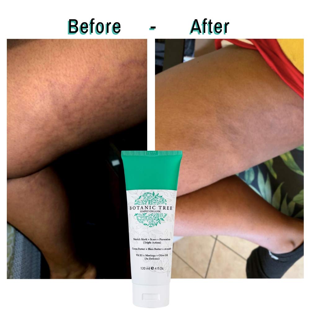 centella asiatica cream for stretch marks