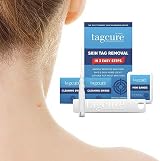 TagCure Skin Tag Removal Kit - Includes 10 Tag Bands, 10 Swabs & 10 Plasters view 6