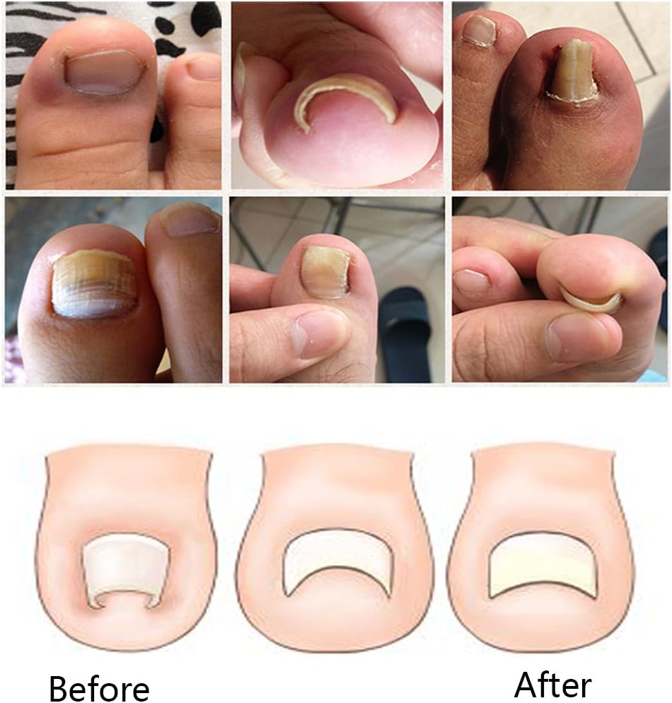 Professional Stainless Steel Ingrown Toe Nail Correction Tool Pedicure Tool: Health & Personal Care