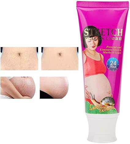 stretch marks on legs removal cream