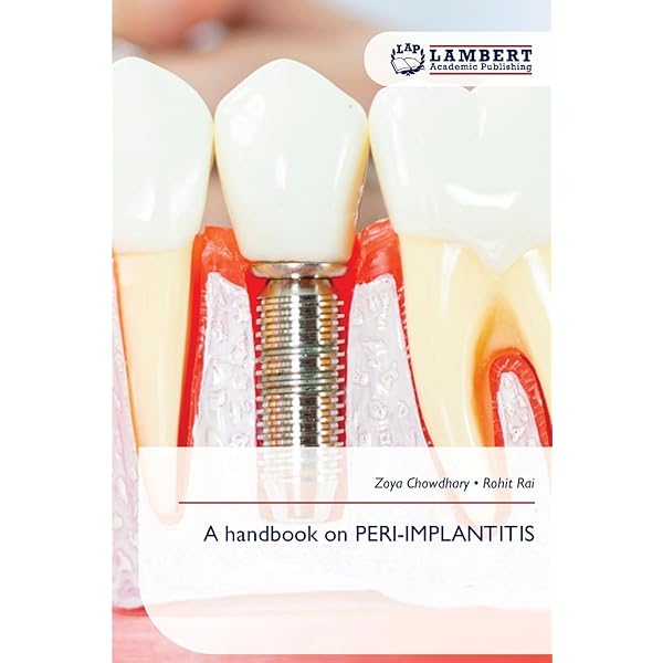 ITI Treatment Guide: Implant Therapy in the Esthetic Zone for