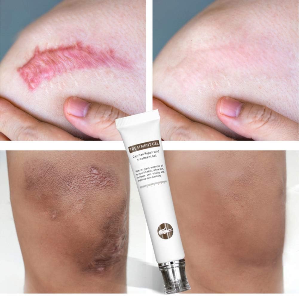 Repair Scar Gel Anti-pimple Anti-acne - Crocodile Essence -Scar Repair Gel - Advanced Acne Pimple Repair Control Oil, Acne Removal, Remove Pimples, Reduces Acne Scars, Acne Marks, Stretch Marks