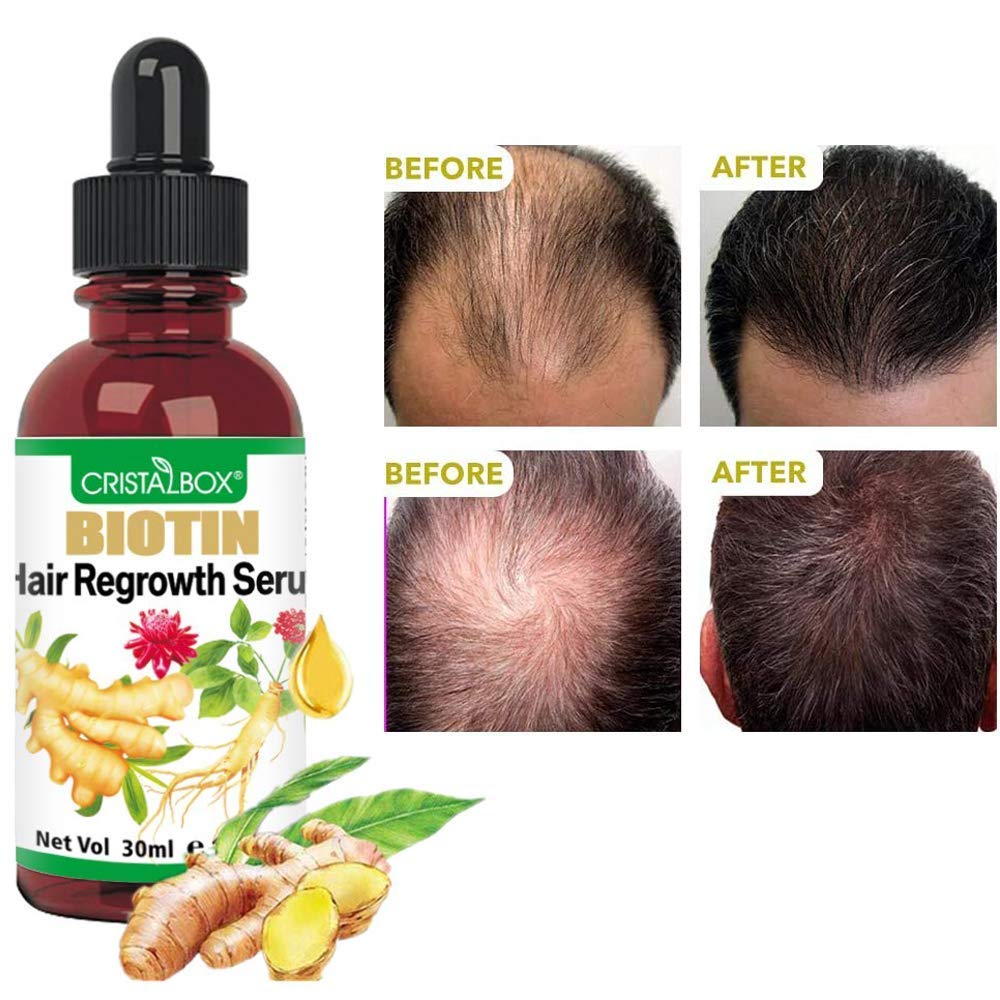 5 PACK Hair Growth Serum, 2021 Biotin Hair Growth Oil, Hair Growth Ginger Serum for Men and Women, Hair Growth Treatment, Ginger Oil for Hair Growth, Hair Loss Treatment, Promotes Thicker, Stronger Hair : Beauty
