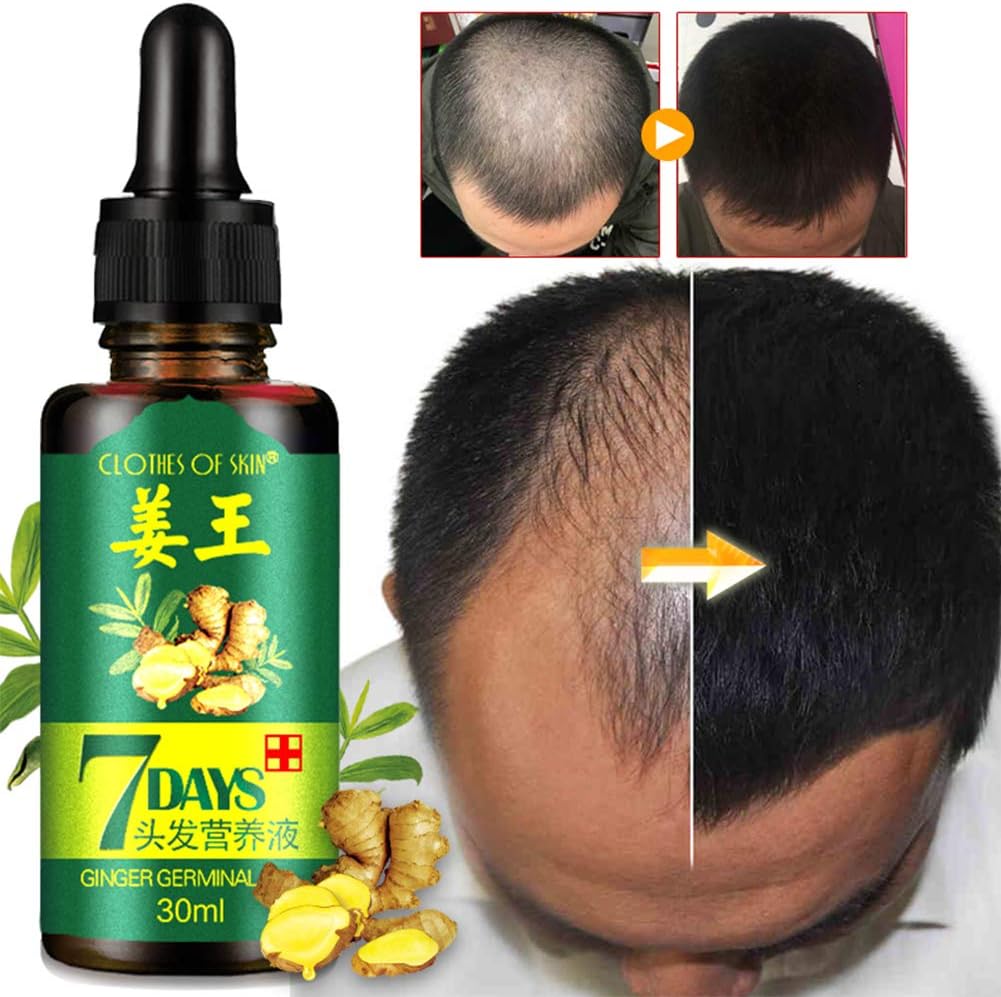 Qlans Ginger Germinal Oil, Hair Growth Serum, Anti Hair Loss,Promote Hair Growth,Hair Care Essential Oil Treatment Preventing Hair Loss Products for Men Women 30ml
