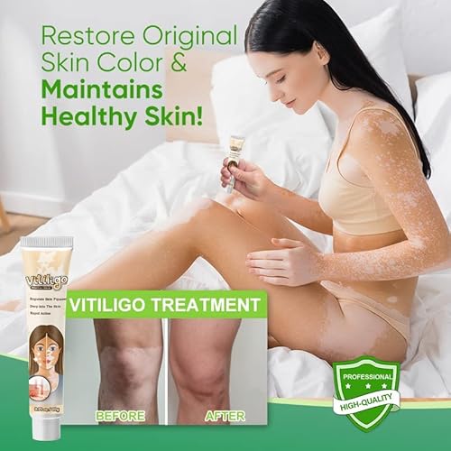 EFINITYER Vitiligo Treatment, Vitiligo Care Cream for Skin Vitiligo,  Vitiligo Treatment for Reduce White Spots and Improve Skin Pigmentation,  Easy to Use in Saudi Arabia | Whizz Face Moisturizers