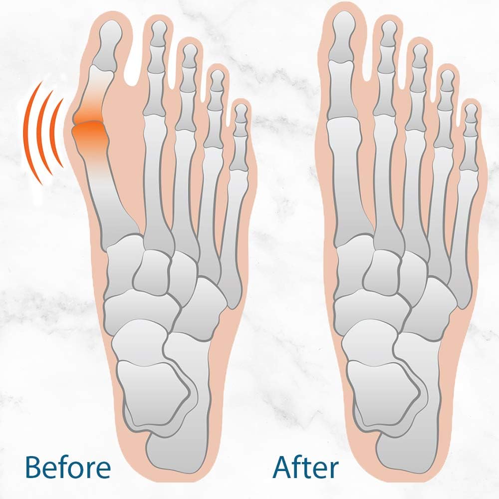 PediDoc Bunion Corrector – Bunion Relief Sleeves Bunion Pads Brace Cushions Toe Straightener with Gel Toe Separator, Spacer, Straightener and Spreader – Hallux Valgus Relief Big Toe Alignment: Health & Personal Care