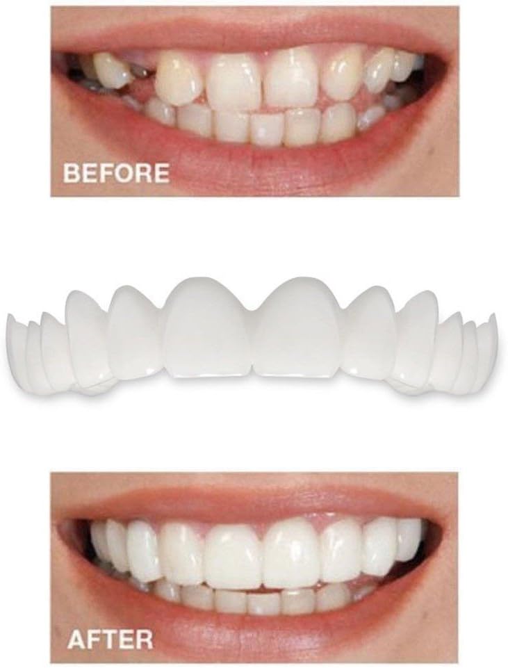 Luckhome 5PC Temporary Smile Comfort Fit Cosmetic Teeth Denture Teeth Top Cosmetic Veneer