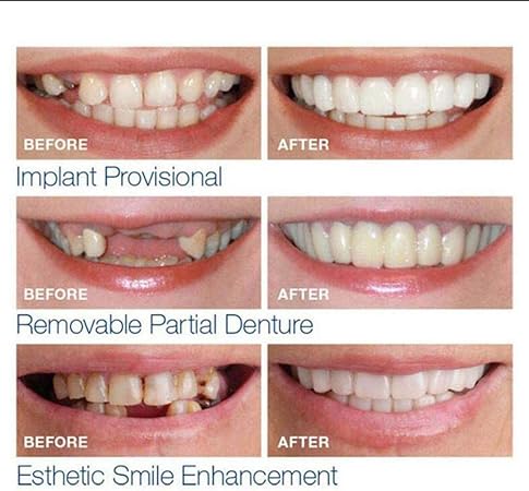 14 Coppie Di Denti Da Sorriso Istantaneo Per La Correzione Dei Denti Per I Denti Cattivi Regalati Un Sorriso Perfetto Veneers Sbiancamento Dei Denti In Basso In Alto Amazon It Casa E