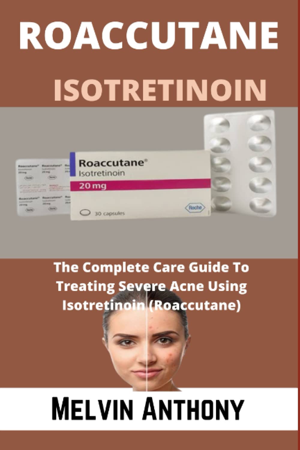 ROACCUTANE ISOTRETINOIN: The Complete Guide To Treating Severe Acne Using Isotretinoin (Roaccutane)