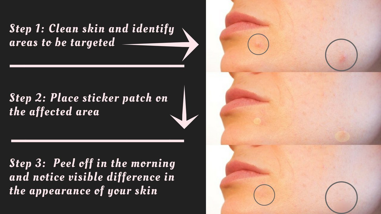 EcoFeminii Pack of 108 Targeted Acne Treatment Sticker Patches - Absorbing Hydrocolloid Covers for Spot Repair - Transparent Dots for Blemishes - Natural and Effective on Oily or Combination Skin - Overnight Acne, Spot and Blackhead Treatme