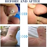 MQ Corn Remover Pads 48 Pcs Foot Corn Plasters with Hole view 4