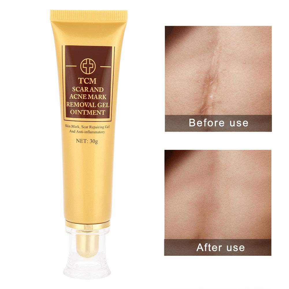 stretch mark removal amazon