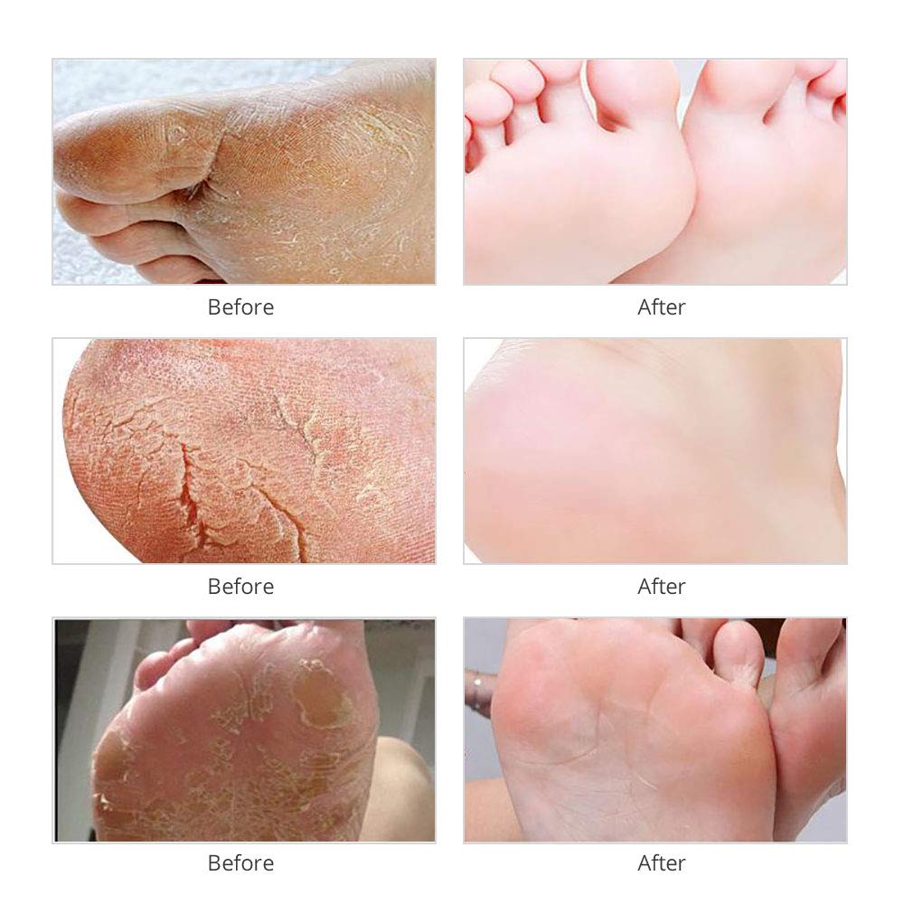 Voglily Foot Peel Mask Exfoliating Booties for Peeling Off Calluses & Dead Skin, Exfoliant for Soft baby Feet, Men & Women Upadted Version 2 Pack: Beauty