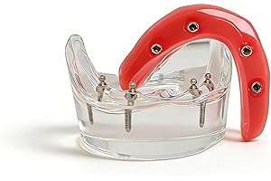 Dental Implant Model,Implant Overdenture Restoration Model,Lower Jaw with 4 Implants,Removable Denture