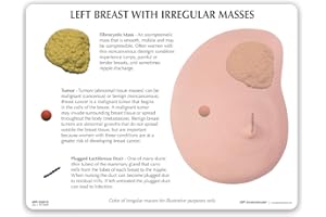 GPI Anatomicals - Human Anatomy Model of Left Breast with Irregular Masses, Replica for Anatomy and Physiology Education, Anatomy Model for Doctor's Office and Classrooms, Medical Learning Resources