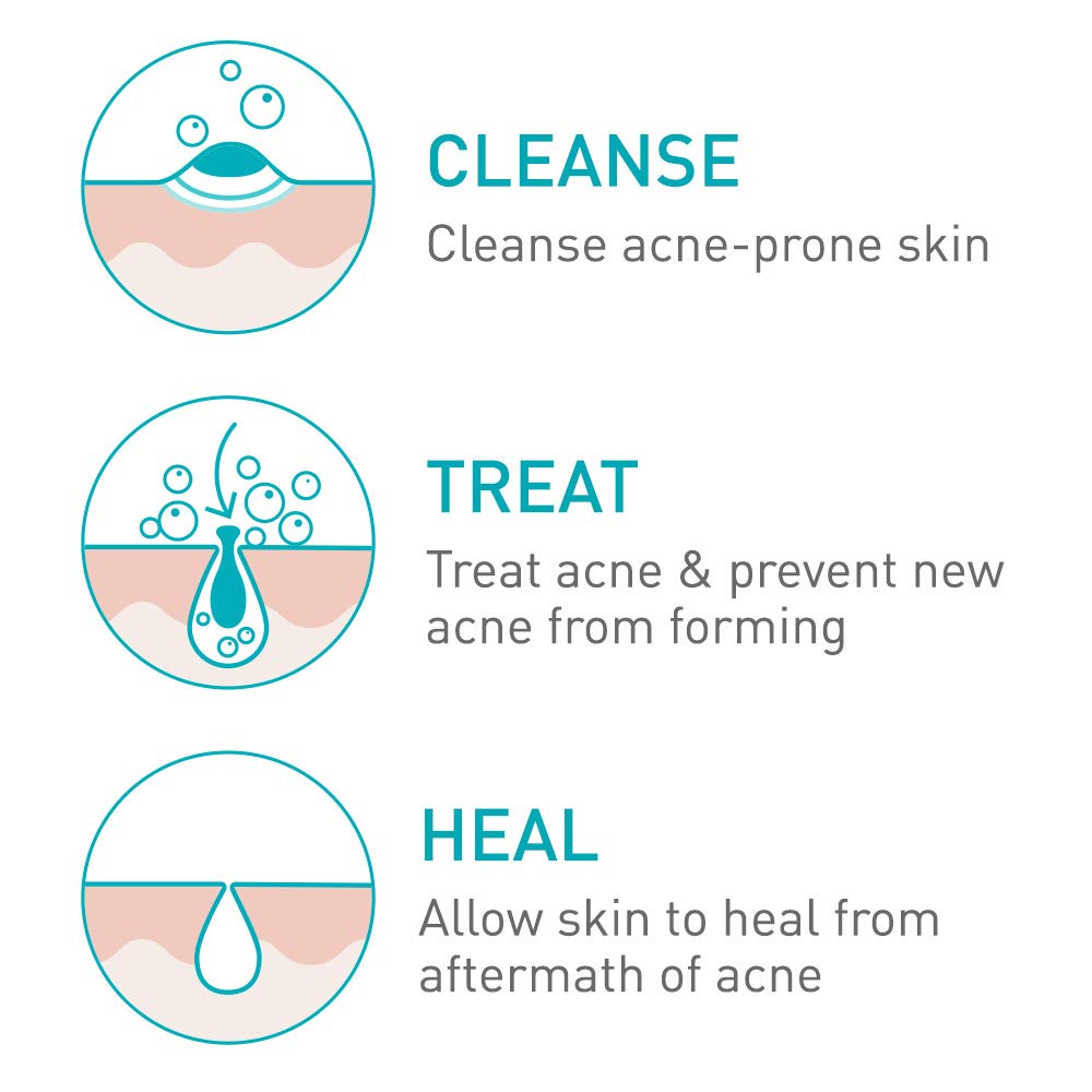 CeraVe Acne Foaming Cream Cleanser | Acne Treatment Face Wash with 4% Benzoyl Peroxide, Hyaluronic Acid, and Niacinamide | Cream to Foam Formula | 5 Oz: Beauty