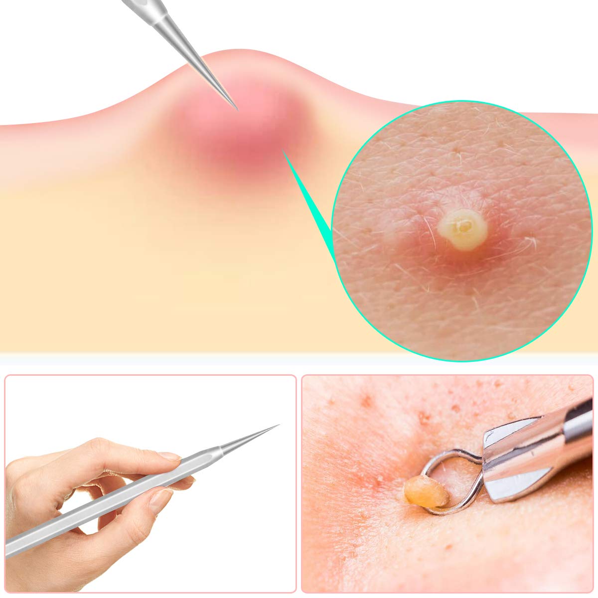 Pimple Popper Tool Kit,Blackhead Remover kit,christmas gifts Stocking Stuffers 6 PCS Ingrown Hair Removal Kit,White heads Removers,Pore Extraction Tool,Facial Skin Acne Zit Tools With A Leather Bag: Beauty