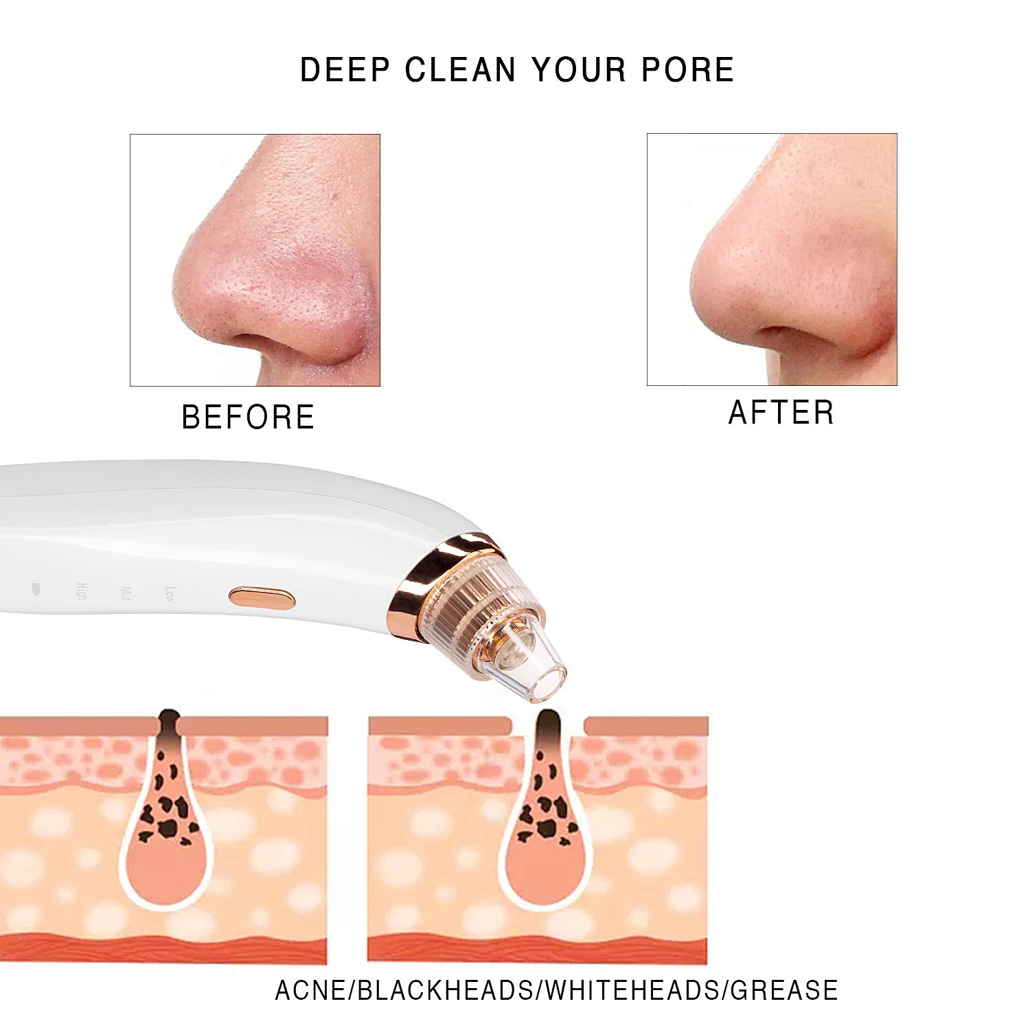 Blackhead Remover Pore Vacuum,ZAOZAOZAN Black Head Removal Tool USB Rechargeable for Blackhead Whitehead,3 Adjustable Suction Power and 4 Porbes: Beauty