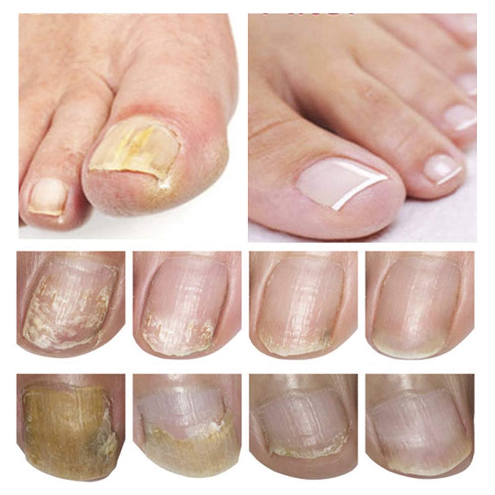 Nail Repair, Nail Solution, Natural Nail Treatment, Effective Against Nail Infection Restores Discolored & Damaged Nails : Beauty