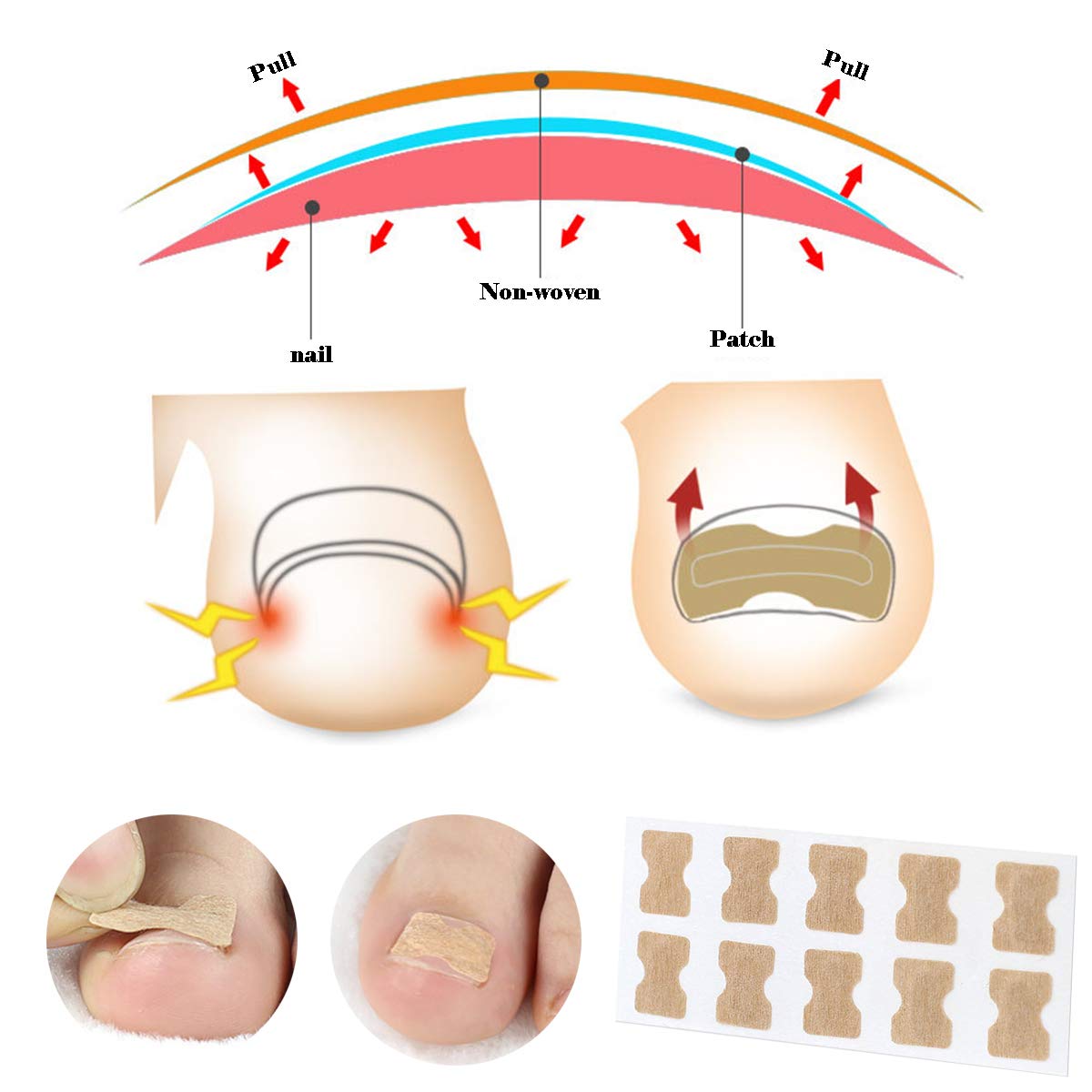 Ingrown Toenail Tools Kit, Include 2pcs Ingrown Toenail Correction Buckle and Toenail Lifter, 2 Sheets Ingrown Toenail Correction Patches for Ingrown Toe Nails Foot Care Tools: Beauty